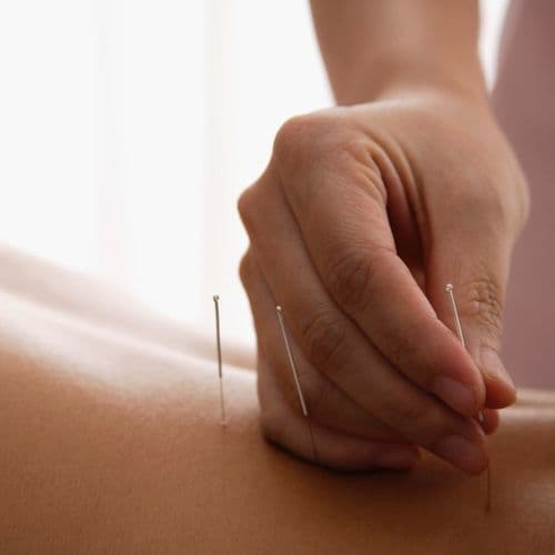 Acupuncture
